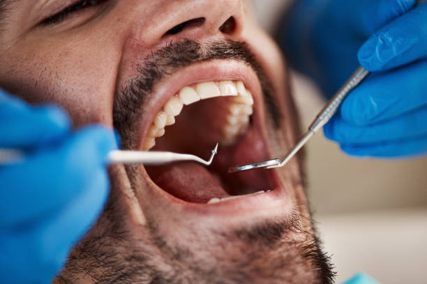 Best Emergency Wisdom Tooth Extraction in Salida, CA